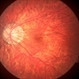 Myopic fundus
