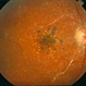 Primary Hyperoxaluria and Oxalosis