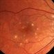 Punctate Inner Choroidopathy with CNV Treated with Bevacizumab # 6 of 7 Punctate Inner Choroidopathy with CNV Treated with Bevacizumab # 6 of 7