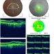Resistant Wet AMD Responsive on Aflibercept