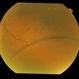 Bilateral Senile Retinoschisis