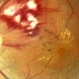Hypertensive Retinopathy Hypertensive Retinopathy