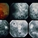 Proliferative Diabetic Retinopathy Proliferative Diabetic Retinopathy