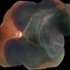 Massive Submacular Hemorrhage