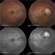 Cystercercosis