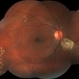 Laser Induced BRAO in IRVAN Syndrome Laser Induced BRAO in IRVAN Syndrome