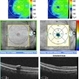 Sub-ILM Heme in patient with Roth Spots - Bacterial Endocarditis Sub-ILM Heme in patient with Roth Spots - Bacterial Endocarditis