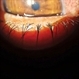 Herpes Simplex Herpes Simplex