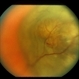 Choroidal Melanoma