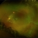 Retinopathy of Prematurity Retinopathy of Prematurity