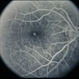 Macular Hole Evolving / Lamellar Hole Macular Hole Evolving / Lamellar Hole