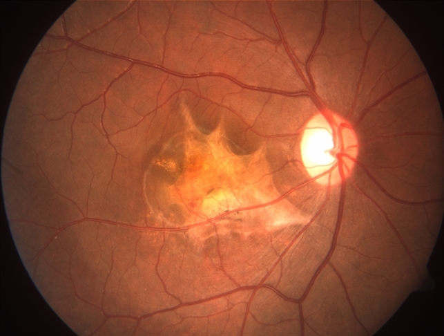 Cnvm Secondary To Choroidal Rupture Retina Image Bank