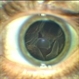 Rhegmatogenous Retinal Detachment Rhegmatogenous Retinal Detachment