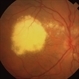Retinal Angioma Retinal Angioma