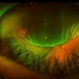 Retinal Detachment