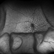 Idiopathic Uveal Effusion Syndrome Idiopathic Uveal Effusion Syndrome