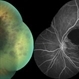 Combined Retinal Artery Macro Aneurysm with Retinal Vein Occlusion Combined Retinal Artery Macro Aneurysm with Retinal Vein Occlusion