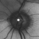 Branch Retinal Artery Occlusion With Calcium Embolus at the Disc - Fundus Autofluorescence Imaging (FAF)