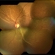 Macular Fold Following Retinal Detachment Surgery Macular Fold Following Retinal Detachment Surgery