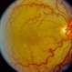 Tortuous Retinal Vessels