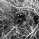 PCV and Peripheral Hemorrhagic Choroidopathy PCV and Peripheral Hemorrhagic Choroidopathy