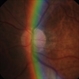 Fundus Photo Fundus Photo