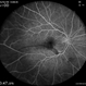 Branch Retinal Artery Occlusion Branch Retinal Artery Occlusion