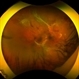 Severe Proliferative Diabetic Retinopathy