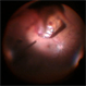Glass intraocular foreign body Glass intraocular foreign body