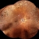 Retinopathy of Prematurity