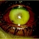 Endophthalmitis Complicating an Intraocular Foreign Body Endophthalmitis Complicating an Intraocular Foreign Body