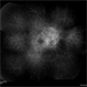 Vogt-Koyanagi-Harada Syndrome