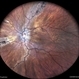 Pigmented Paravenous Retinochoroidal Atrophy Pigmented Paravenous Retinochoroidal Atrophy