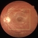 Macular Burn from Nonmedical Lasers