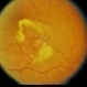 BDR / Macular Edema / Macroaneurysm BDR / Macular Edema / Macroaneurysm