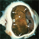 Sympathetic Ophthalmia Sympathetic Ophthalmia