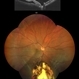 Retinal detachment, Coloboma Retinal detachment, Coloboma