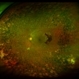 Diabetic Retinopathy Diabetic Retinopathy