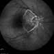 Central Retinal Artery Occlusion Central Retinal Artery Occlusion