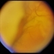 Superchoroid Hemorrhage
