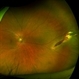 Posterior Scleral Laceration