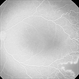 Latrogenic Oxygen Induce Retinopathy  in a Premature Baby