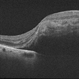 RAMA, Valsalva Retinopathy RAMA, Valsalva Retinopathy