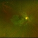 Serpiginous Choroidal Atrophy Serpiginous Choroidal Atrophy