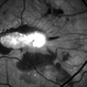 Subretinal Thickening and Subretinal Hemorrhage – Red Free (B/W) Photograph