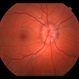 Optic Nerve Edema Optic Nerve Edema
