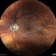 Synechiae Synechiae