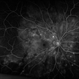 'Starry Sky' Fundus in Vogt-Koyanaki-Harada Syndrome