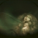 Retinal Detachment With Coloboma of Macula