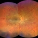 Proliferative Diabetic Retinopathy